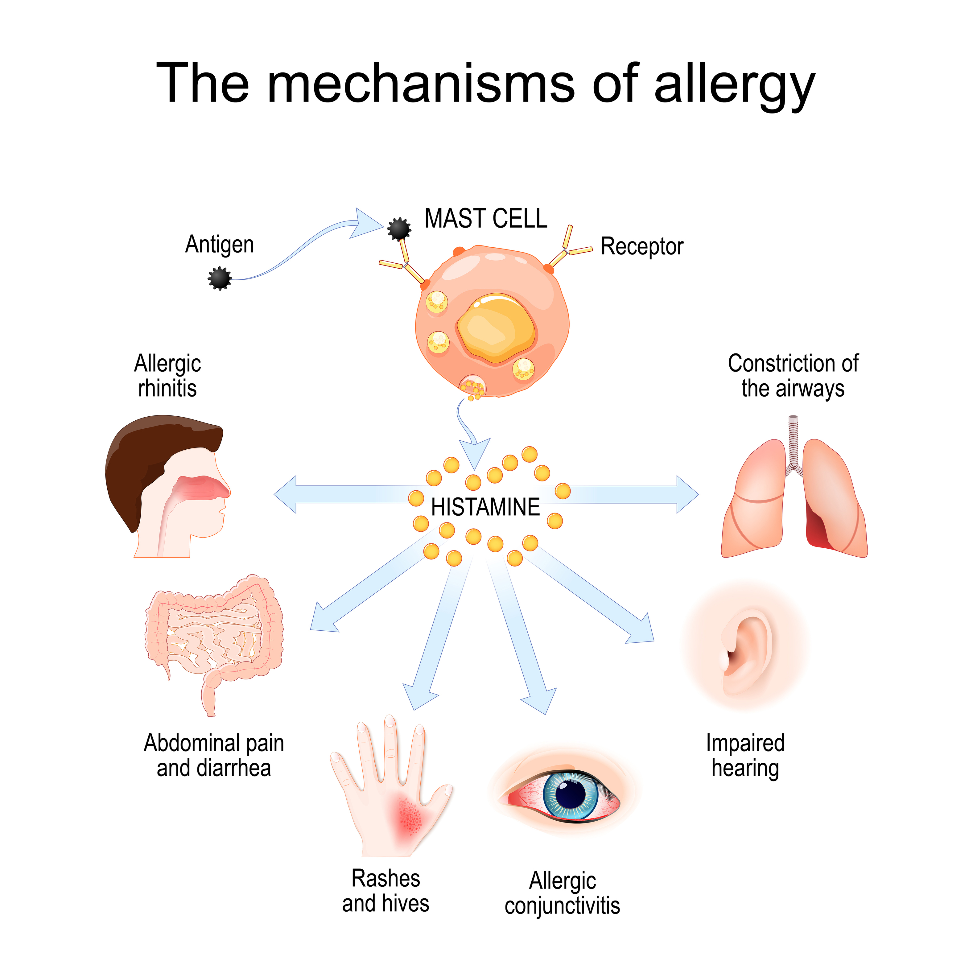 Mast Cell Allergy